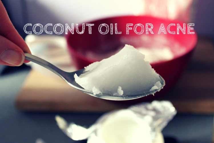 coconut-oil-for-acne-treatment-hickey-solution