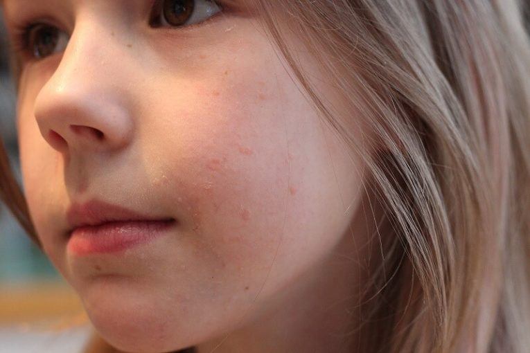 Facial Warts How To Get Rid Of Warts On Your Face Hickey Solution